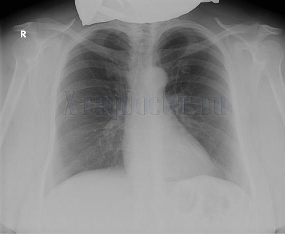 нормальная рентгенограмма легких